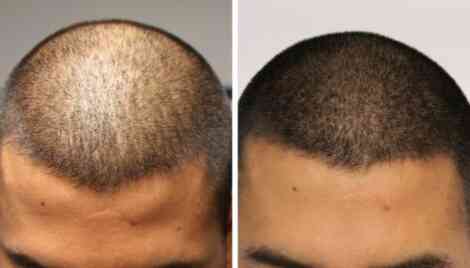 scalp-micropigmentation